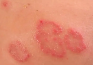 Clinical photo of nummular (discoid) eczema — well-defined round coin-shaped red scaly patches on skin.