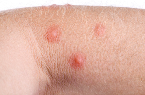 Red bumps on skin — insect bite reaction showing raised red bumps on the arm.