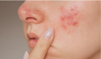 Red spots on face — rosacea showing persistent redness and small red bumps on the cheek.