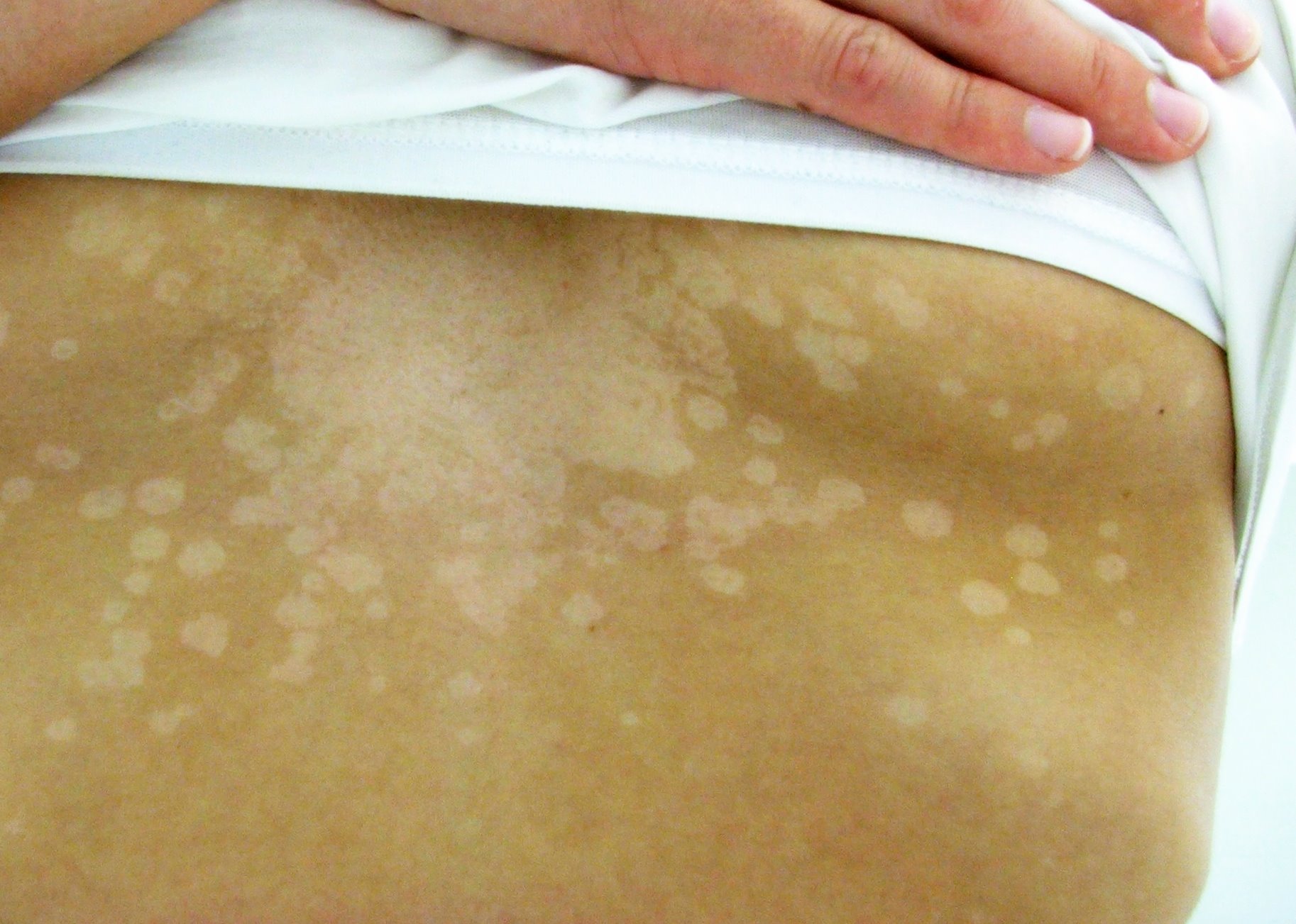 Tinea versicolor — light, slightly scaly patches on the back.