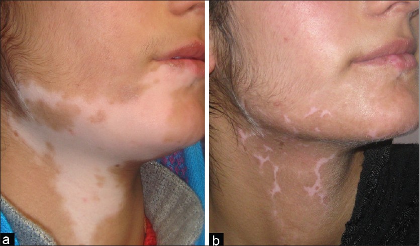Vitiligo — well-defined milk-white patches on skin.
