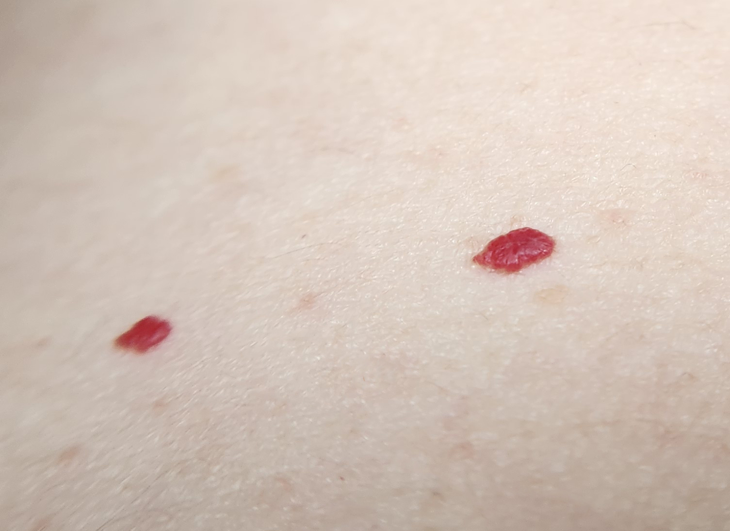 Cherry angioma — bright red dome-shaped spot on skin.