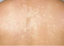 Clinical photo of tinea versicolor — pale, slightly scaly patches on the upper back.
