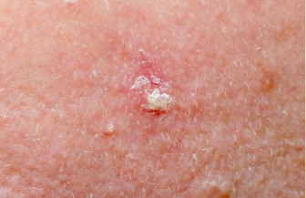 Actinic keratosis — rough, scaly, pink-red patches on sun-exposed skin.