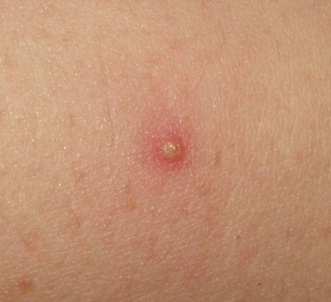 Folliculitis — small red bumps centred on hair follicles.
