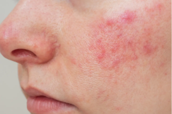 Rosacea on face — persistent central-face redness with small red bumps on the cheek.