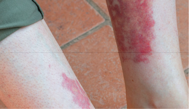 Vasculitis on the legs — red-purple patches and spots on the lower shins.