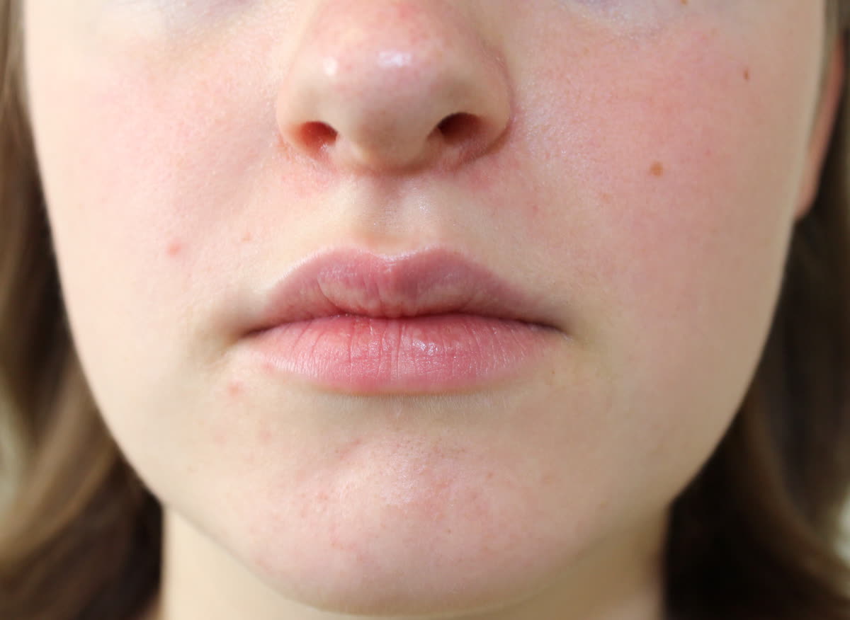 Perioral dermatitis — small red bumps around the mouth.