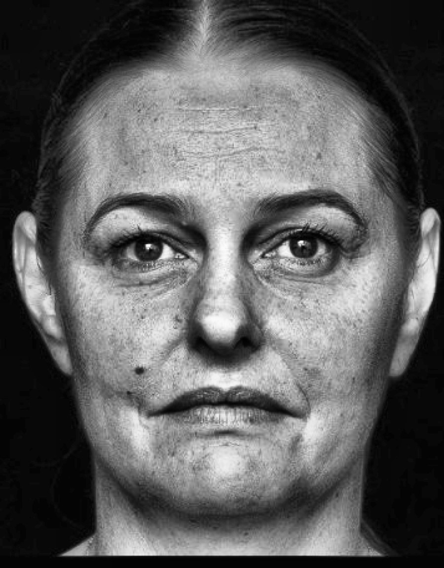 Enhanced grayscale facial skin analysis showing visible texture, pores, fine lines and uneven surface detail