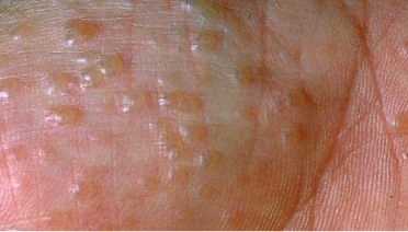 Clinical photo of dyshidrotic eczema — clusters of tiny deep-seated fluid-filled blisters on the skin.