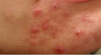 Red bumps on face — inflamed acne papules on the cheek and jaw.