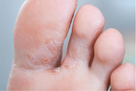 Clinical photo of athlete's foot — peeling, macerated skin between the toes.