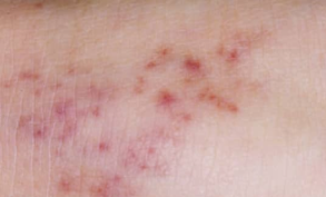 Petechiae vs purpura on skin — close-up of pinpoint red-purple spots.