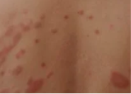 Clinical photo of seborrheic dermatitis — red inflamed skin with scattered scaly papules on the trunk.