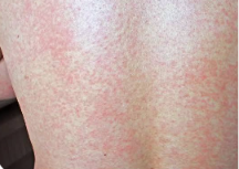 Clinical photo of a viral exanthem — diffuse pink-red flat and slightly raised spots covering the skin, often with fever.