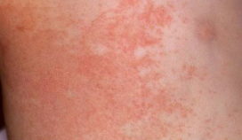 Clinical photo of heat rash (miliaria) — small red papules clustered on skin from blocked sweat ducts in hot, humid conditions.