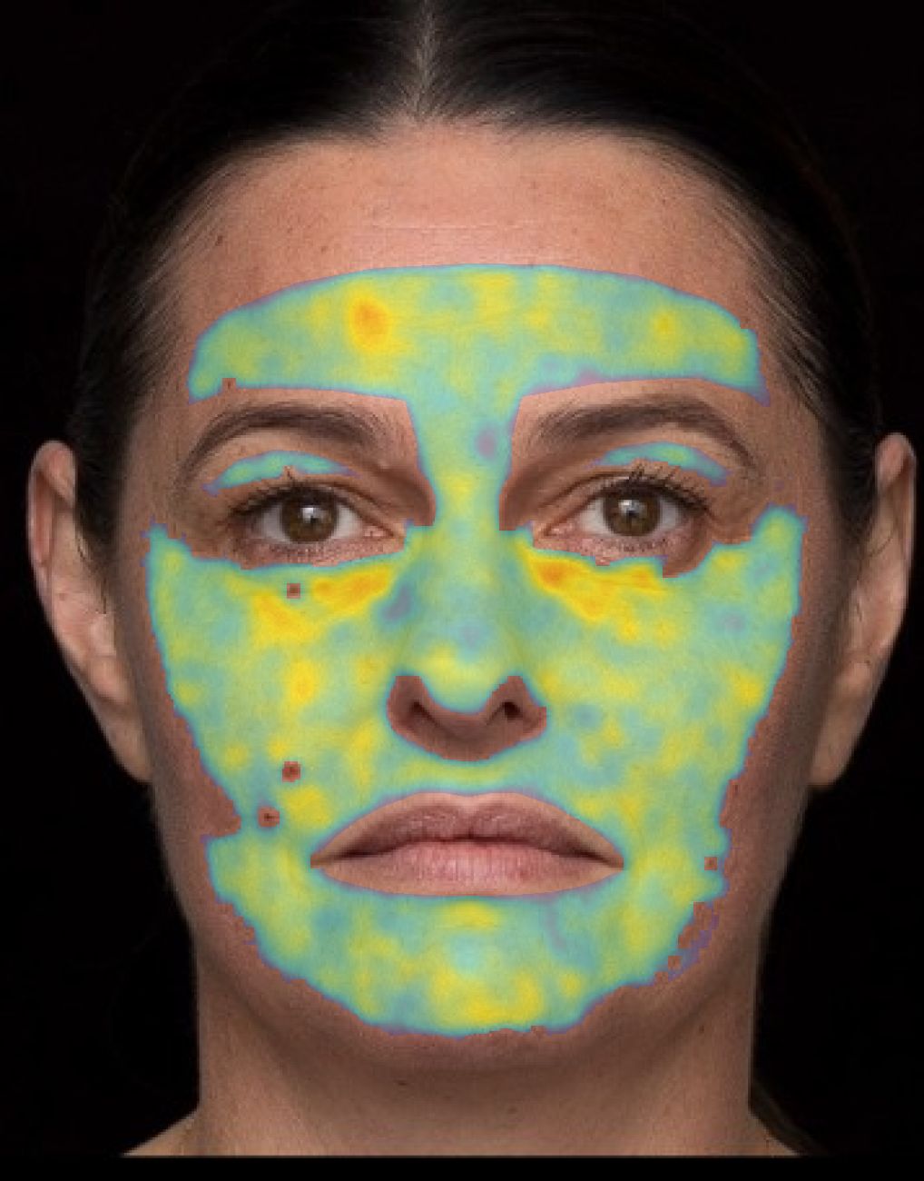 Facial skin texture heatmap with blue, green and yellow overlays across the forehead, cheeks, nose and chin