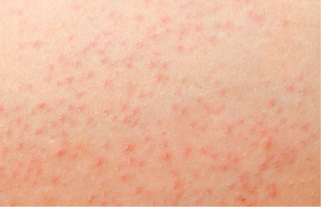 Post-shave folliculitis on legs — red inflamed hair follicles after shaving.