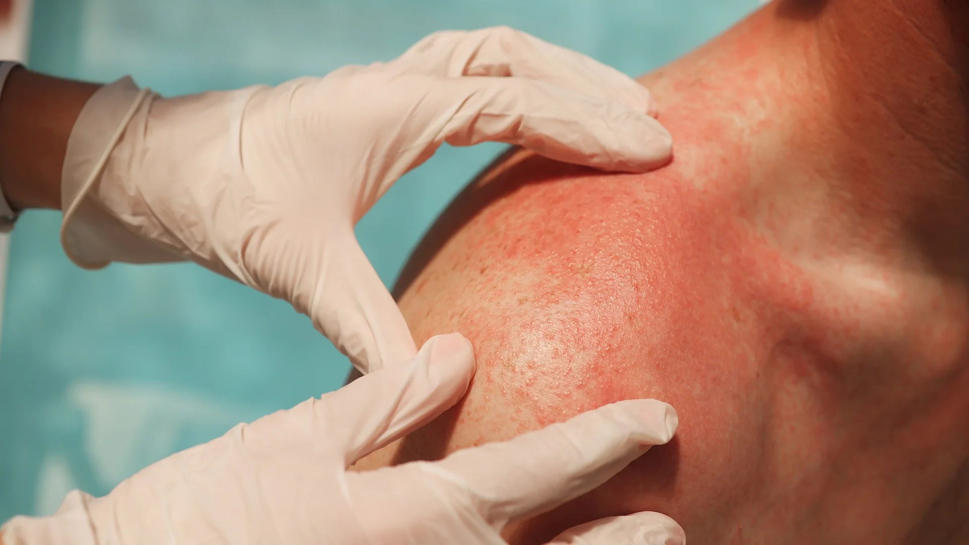 Drug rash on skin — widespread red medication reaction on the back.