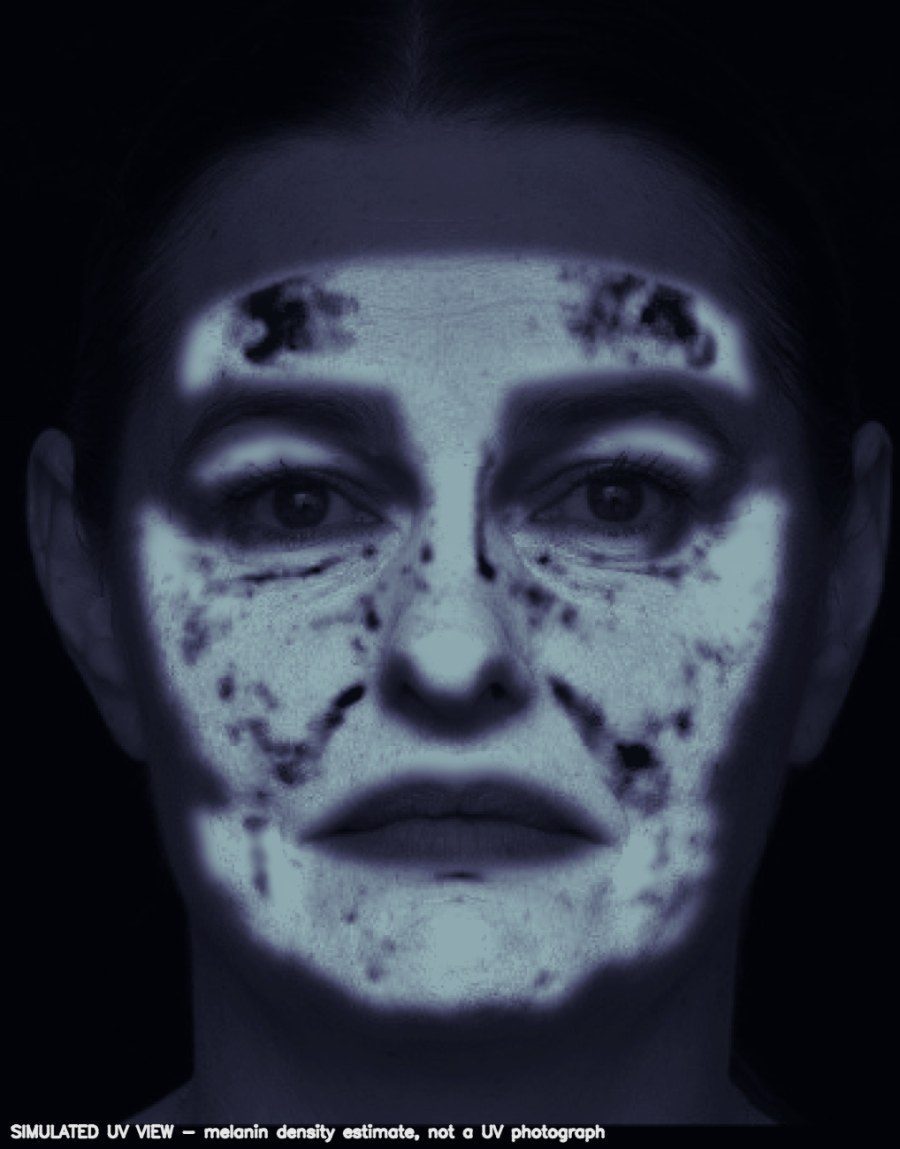 Simulated UV-style facial visualisation estimating areas of higher melanin density from a standard RGB photograph