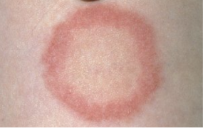 Clinical photo of ringworm (tinea corporis) — a round red patch with a raised scaly edge and clearer centre.