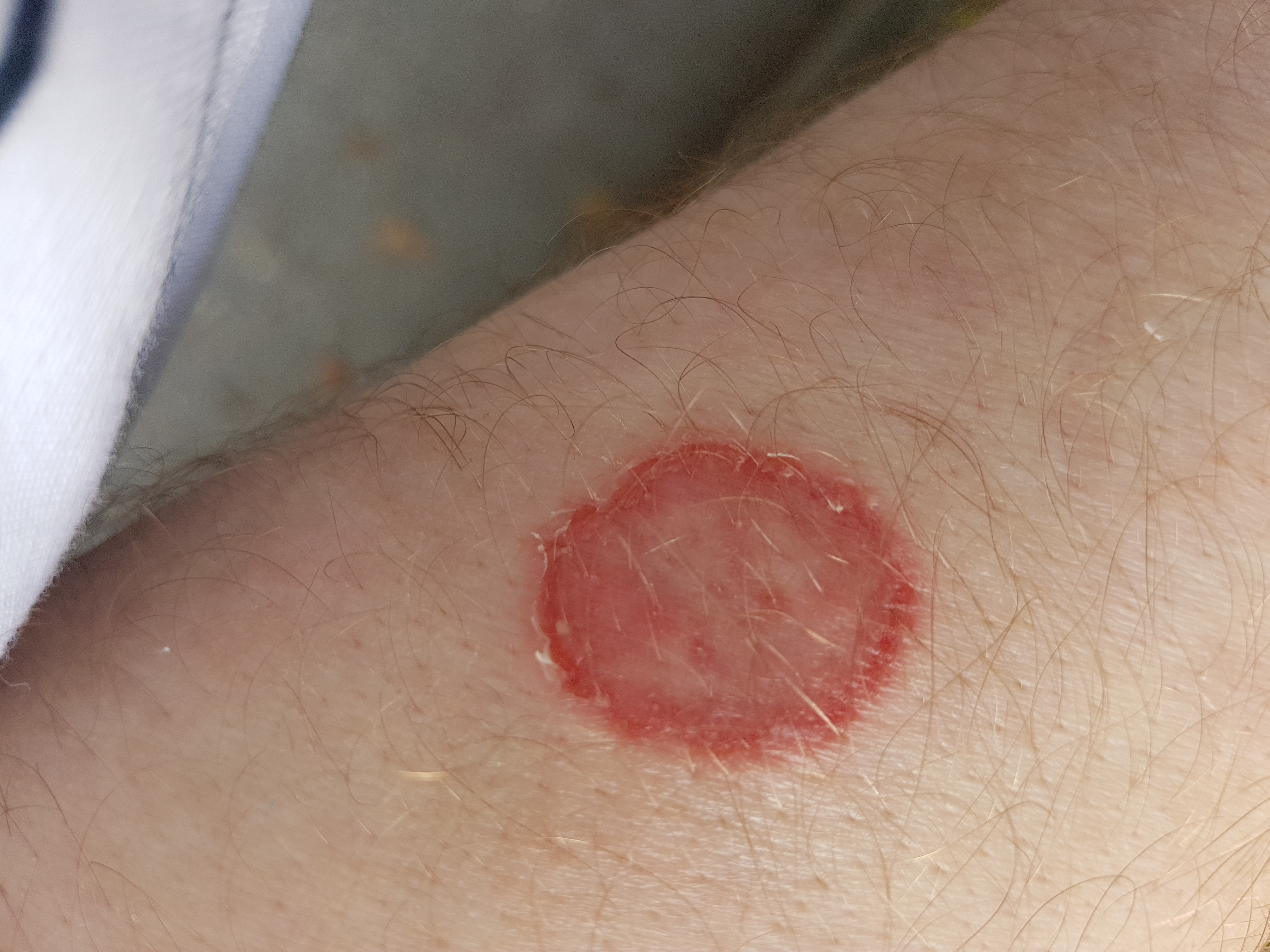 Ringworm (tinea corporis) — ring-shaped itchy rash with raised scaly edge.
