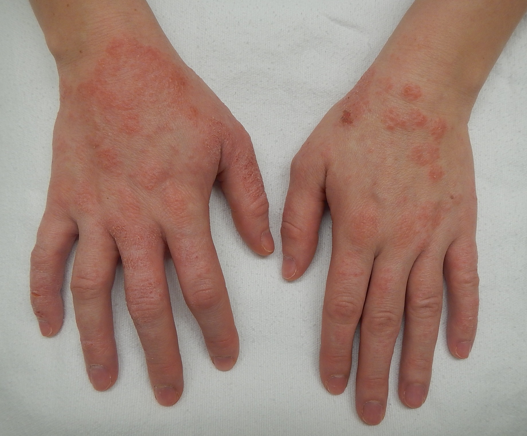 Eczema rash — dry, itchy, red inflamed skin.
