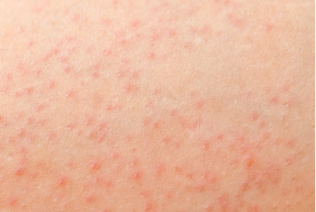 Petechiae on skin — pinpoint non-blanching red dots on light skin.