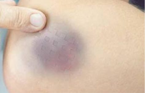 Purpura on skin — larger purple non-blanching patch with finger pressing nearby for scale.