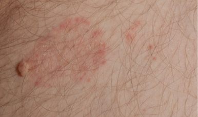 Clinical photo of jock itch (tinea cruris) — red, scaly rash on hairy skin.