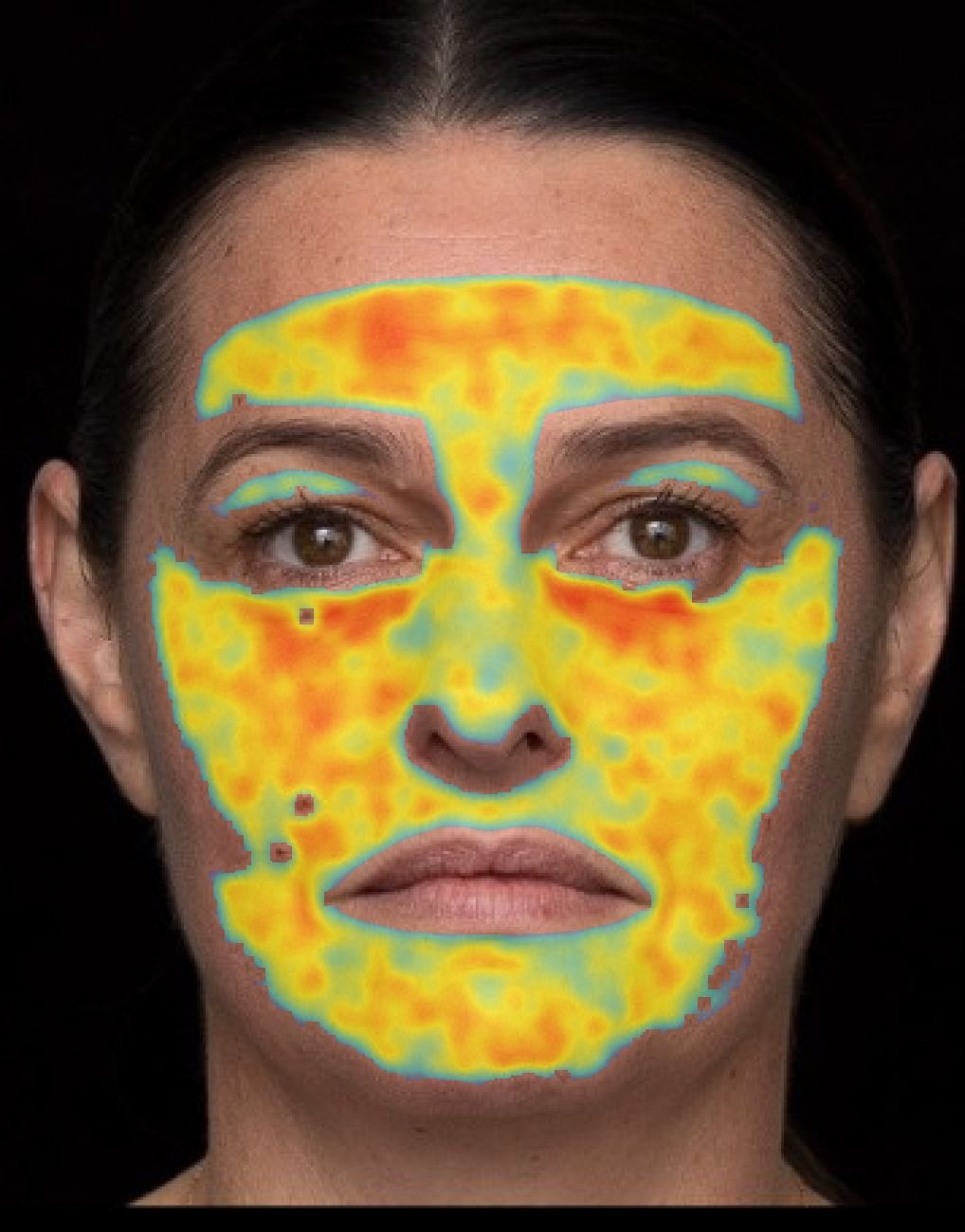 Facial Analysis Pro — Concern heatmaps example view
