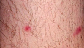 Red bumps on legs — inflamed folliculitis spots on a hairy leg.