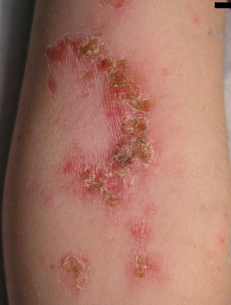 Impetigo — red bumps with honey-coloured crusts.