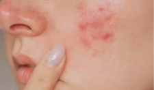 Clinical photo of rosacea — persistent redness with small red bumps and visible vessels across the central face.
