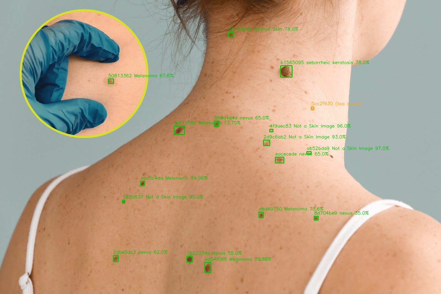 ScanSkinAI multi-lesion detection API output — annotated upper back and neck photo with bounding boxes labelling each mole as melanoma, nevus, seborrheic keratosis or normal skin, each with a per-lesion confidence score.