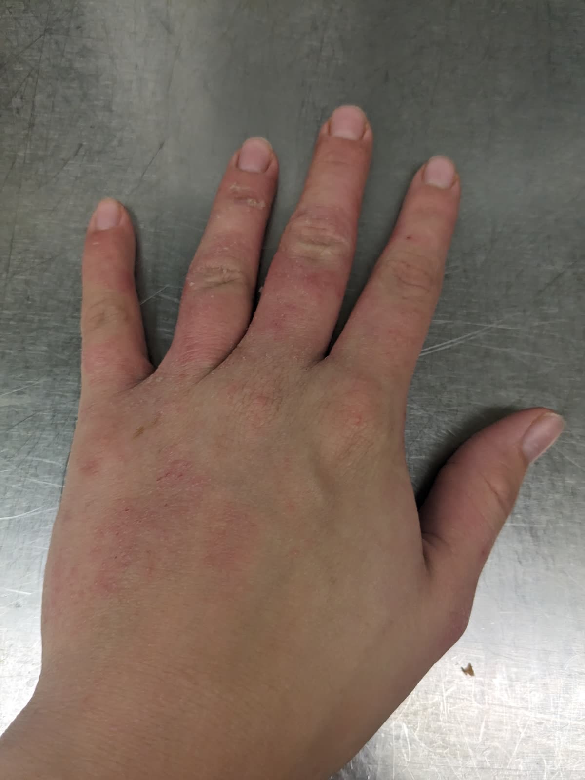 Contact dermatitis — red irritated skin from soap or chemical exposure.