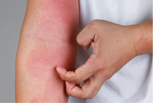 Itchy rash on skin — red, inflamed eczema-like rash on an adult arm.