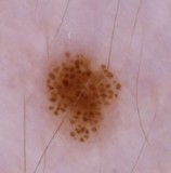 ABCDE Asymmetry — example of asymmetry in a mole (Asymmetric)