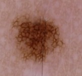 ABCDE Border — example of border in a mole (Irregular border)