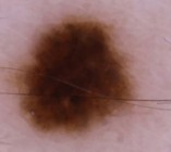 ABCDE Colour — example of colour in a mole (Multiple colours)