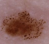ABCDE Diameter — example of diameter in a mole (>6 mm)