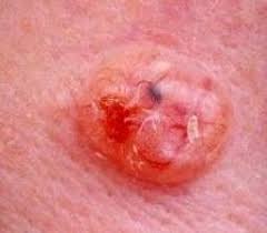 Ulcerated basal cell carcinoma on the arm showing a raised pink lesion with a central crusted ulcer and rolled pearly border — classic 'rodent ulcer' BCC