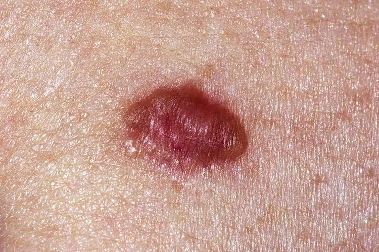 Pigmented basal cell carcinoma on the chest showing a dark brown-purple raised lesion with a pearly translucent edge, can mimic melanoma