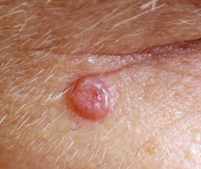 Basal cell carcinoma near the eye showing a small dome-shaped, translucent pearly papule on the lower eyelid skin — common location for facial BCC