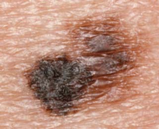 Melanoma on the arm showing notched, irregular borders with mixed black and brown pigmentation on light skin — example of ABCDE 'B' (Border irregularity)