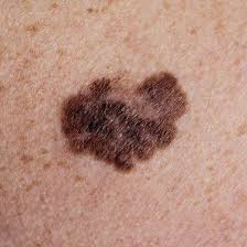 Multi-coloured melanoma lesion on the back with brown, black and reddish-pink pigmentation — example of ABCDE 'C' (Colour variation) warning sign