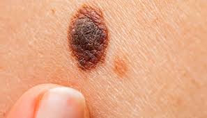 Raised nodular melanoma on the leg with dark central elevation and surrounding pigmentation — example of ABCDE 'D' (Diameter over 6mm) and elevated EFG warning sign