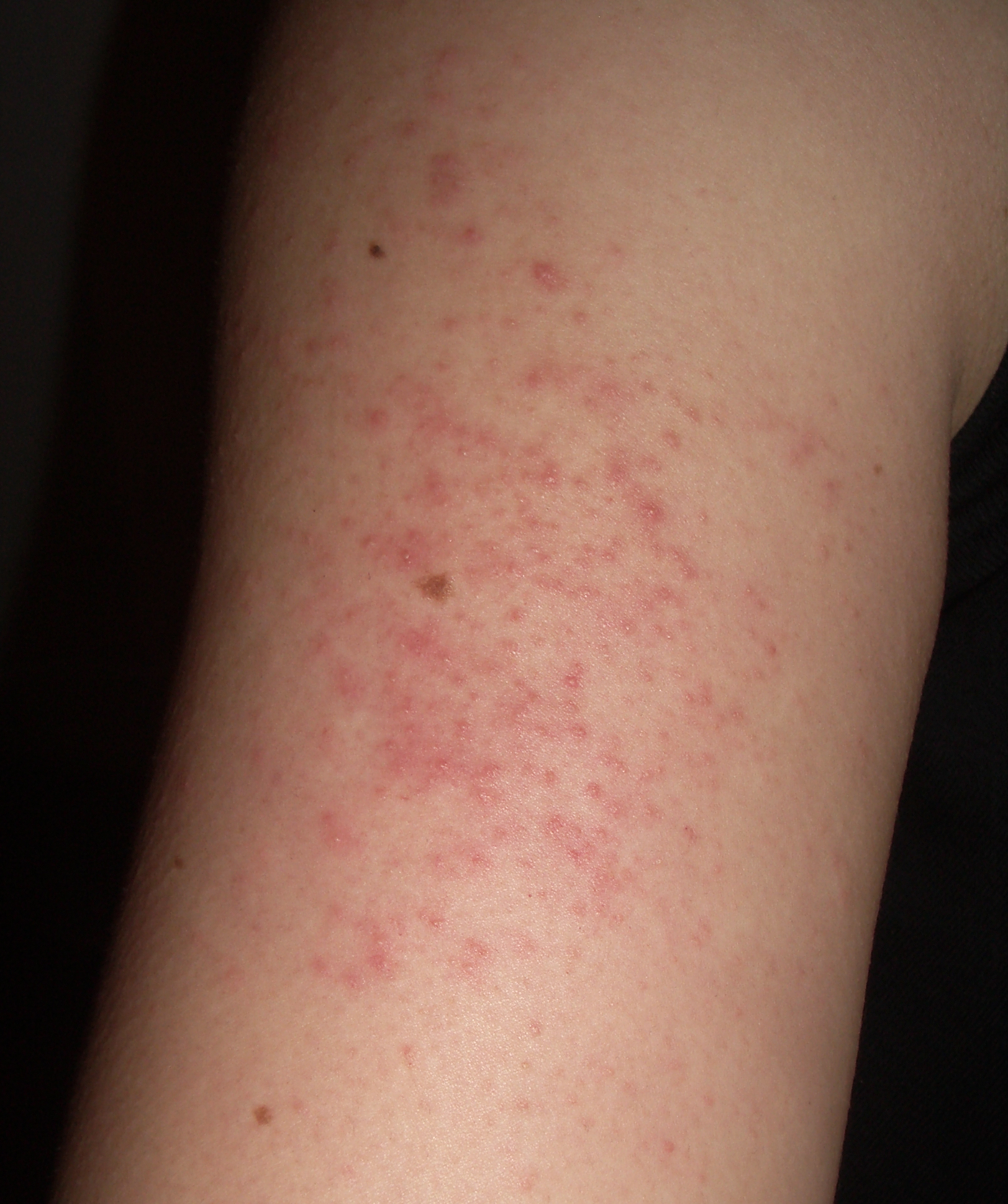 Red bumps on arms — keratosis pilaris with tiny rough bumps on the upper arm.