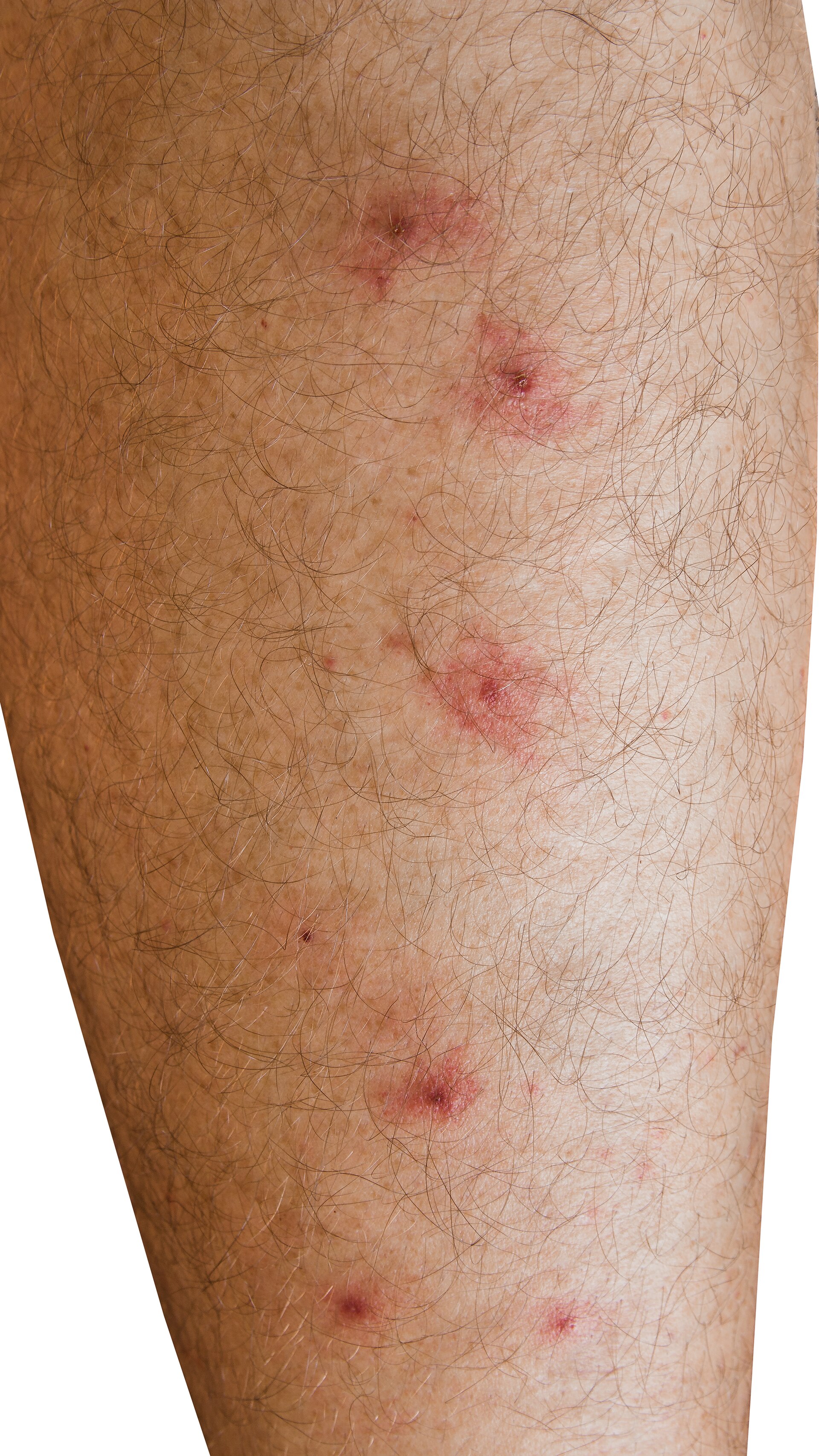 Red bumps on skin — insect bite reaction with clustered red bumps on the shins.