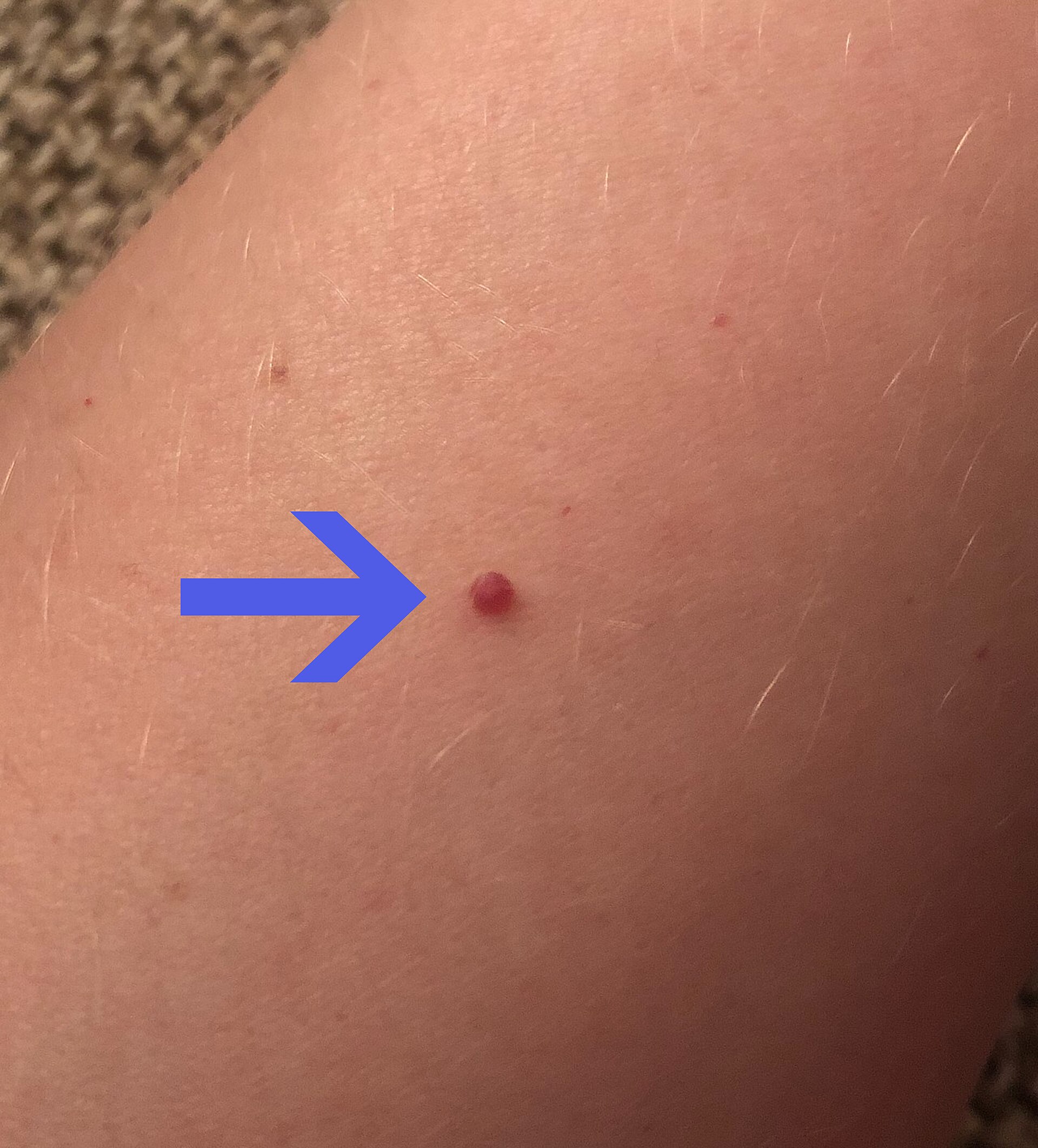 Red dots on skin — cherry angiomas showing small bright red spots.